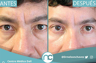 Blefaroplastia 3