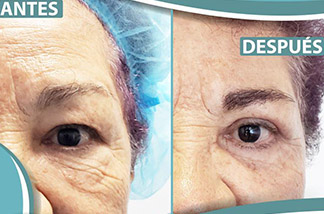 Blefaroplastia 2