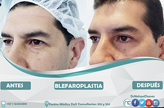 Blefaroplastia 1