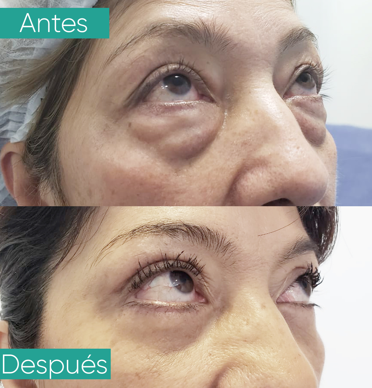 Blefaroplastia 18